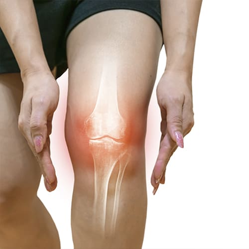 Reemplazo de rodilla o artroplastia de rodilla