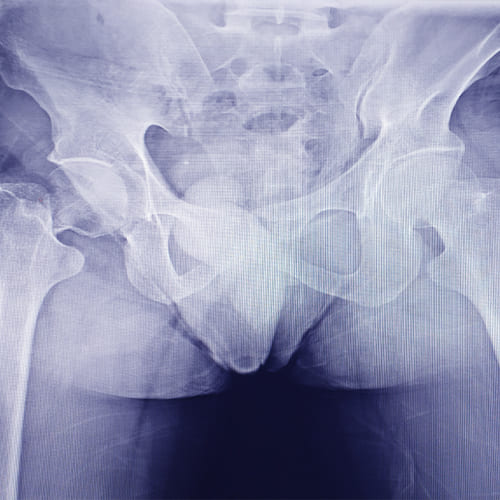 Reemplazo de cadera o artroplastia de cadera